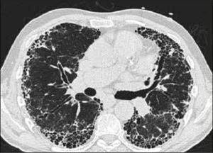 PATRÓN DE FIBROSIS Y UIP: FIBROSIS PULMONAR IDIOPÁTICA.