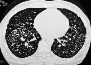 PATRÓN NODULAR/MICRONODULAR: SARCOIDOSIS.