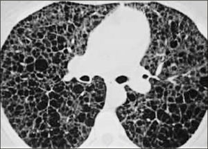 PATRÓN MOSAICO/QUÍSTICO: LINFANGIOLEIOMIOMATOSIS.