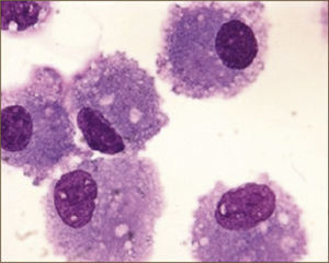 MACRÓFAGOS ALVEOLARES (Tomado con autorización de www.wasog.org, BAL Atlas: © ild care foundation).