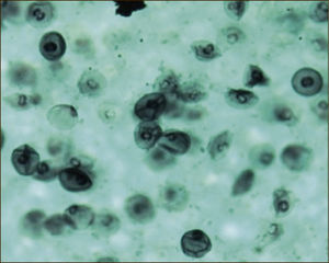 LAVADO BRONQUIOALVEOLAR: TINCIÓN DE GROCOTT PARA PNEUMOCYSTIS JIROVECI (Tomada con autorización de www.wasog.org, BAL Atlas: © ild care foundation).
