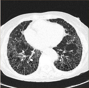 Corte de regiones basales de pulmón en TAC de UI.