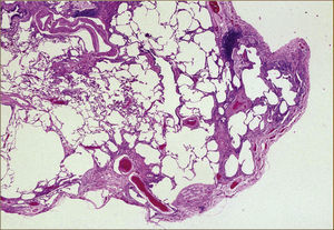 Histopatología de UIP.