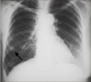 Nódulo Pulmonar Solitario.