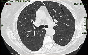 Nódulo Sólido de 11mm LSI, Adenocarcinoma Invasor.