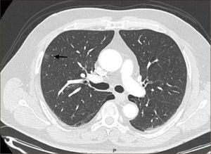 Nódulo en vidrio esmerilado de 9mm en LSD, adenocarcinoma in situ.