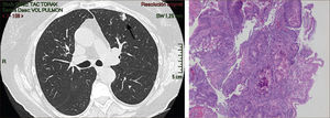 Nódulo con componente sólido cercano al 90% de 14mm: Adenocarcinoma Invasor.
