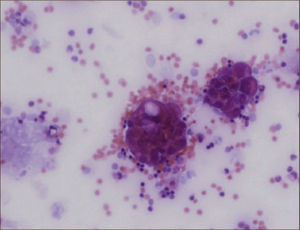 CITOLOGÍA POSITIVA PARA ADENOCARCIOMA Gentileza Dra. Cristina Fernández.