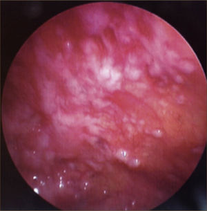 COMPROMISO TUMORAL, CON NODULACIONES EN LA PLEURA PARIETAL.