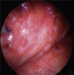 COMPROMISO TUMORAL, CON NODULACIONES EN LA PLEURA DIAFRAGMÁTICA.