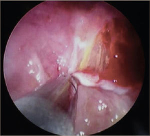 TOMA DE BIOPSIA BAJO VISIÓN DIRECTA SOBRE PLEURA PARIETAL.