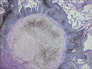 Nódulo silicótico Está constituido por un centro de fibras colágenas hialinas que adoptan disposición concéntrica, rodeado de macrófagos cargados de pigmento.