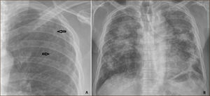 A. Opacidades micronodulares (flechas) en Lóbulo Superior Derecho (LSD) en paciente con silicosis. B. Fibrosis Masiva Progresiva.