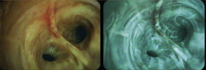 VIDEOBRONCOSCOPIA CON LUZ BLANCA (IZQUIERDA) Y CON AUTOFLUORESCENCIA (DERECHA) DE UNA LESIÓN SOSPECHOSA EN UNA CARINA INTERSEGMENTARIA. IMAGEN CORTESÍA DE ARQUIMED.