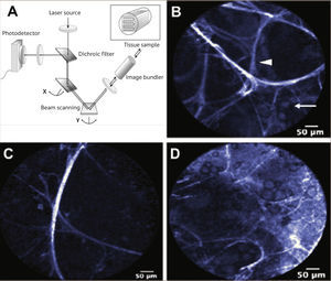 BRONCOSCOPIA CONFOCAL. A) Esquema de funcionamiento. B) Alvéolo normal. Punta de flecha: septo alveolar. Flecha: Macrófagos alveolares. C) Enfisema Pulmonar caracterizado por disminución del número de septos y aumento de los espacios alveolares. D) Aumento del número de macrófagos alveolares. 2.