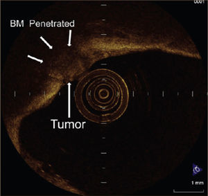 TOMOGRAFÍA DE COHERENCIA ÓPTICA DE UN CARCINOMA ESCAMOSO MICROINVASOR. La membrana basal (BM) posee una alta dispersión y se observa como una línea clara y se aprecia interrumpida por invasión tumoral 1.
