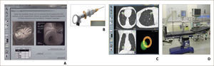 BRONCOSCOPIA CON NAVEGACIÓN ELECTROMAGNÉTICA. A) Software que convierte las imágenes de la Tomografía Axial Computada en una broncoscopia virtual 3D. B) Mango de dirección del sensor que se introduce por el canal de trabajo del broncoscopio. C) Hoja de ruta hasta la lesión. D) Mesa con tabla generadora del campo electromagnético incorporada 8.
