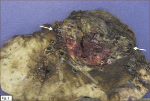 ASPECTO MACROSCÓPICO, TUMOR SUBPLEURAL, BIEN DELIMITADO, HEMORRÁGICO CON PARÉNQUIMA PULMONAR CIRCUNDANTE.