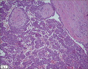 PAPILAS Y ÁREAS SÓLIDAS CON ESCLEROSIS ESTROMAL, RODEADAS POR ESPACIOS VASCULARES. (HE 200X).