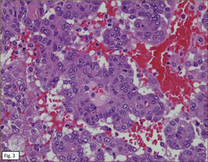 ESTRUCTURAS PAPILARES CON DOS POBLACIONES CELULARES DE UBICACIÓN CENTRAL Y PERIFÉRICA. (HE 400X).