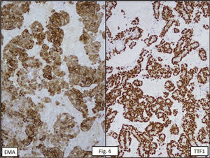 EMA Y TTF1 CON MARCACIÓN POSITIVA INTENSA EN AMBAS POBLACIONES CELULARES.