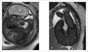 RMF paciente de 28 semanas, con acortamiento de extremidades superiores e inferiores que compromete segmentos proximales (rizomélico). Imagen T2 sagital (A) y T2 axial de extremidades inferiores (B).