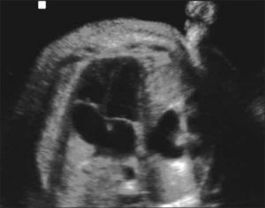 Hernia Diafragmática Izquierda Se observa bolsa gástrica en tórax.
