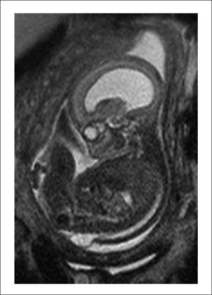 rm fetal feto con mmc lumbar e hidrocefalia.