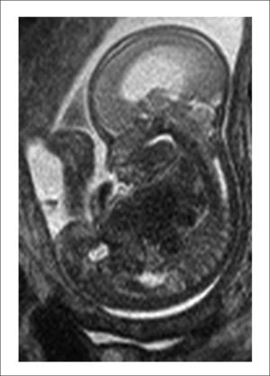 rm fetal feto con malformación de Chiari.