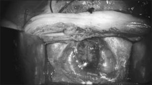 Placa neural expuesta.