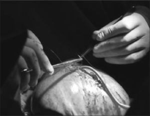 Cierre histerotomia.