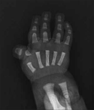 Rx de mano obtenida en período de recién nacido demuestra alteración característica del dedo pulgar correspondiente al síndrome de Rubenstein Taybi.