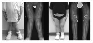 Hemipifisiodesis alrededor de la rodilla en genu valgo secundario a displasia espondilometafisiaria Publicación autorizada por paciente.