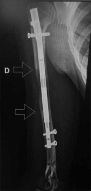Clavo de elongación ósea PRECICE®. Las puntas de flecha muestran el segmento de neoformación ósea.