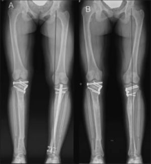 Corrección de Genu Varo con placa tipo Puddu® en paciente portadora de Raquitismo familiar. A) En la Rx preoperatoria, se observa Genu Varo, a pesar de haberse intentado corrección con clavo intramedular. B) Se retiró el clavo, y se practicó una osteotomía valguizante y fijación con placa. Obsérvese que la línea del eje mecánico pasa por el centro de cadera, rodilla y tobillo.