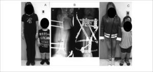 Alargamiento de extremidades inferiores en Acondroplasia A) Paciente junto a su madre preoperación. B) Se observa progresión de la distracción ósea en fémur derecho de aproximadamente 8cm y en tibia de 6cm. C) Resultado final. El paciente ha crecido 15cm. Publicación autorizada por paciente.