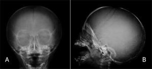 a y b. Rx de cráneo de paciente portador de osteogénesis imperfecta. Se observan alteraciones de osificación y presencia de múltiples huesos wormianos. a) Rx Frontal, b) Rx Lateral.