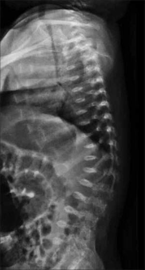 Rx lateral de columna evidencia platiespondilia en paciente portadora de displasia espondilometafisiaria.