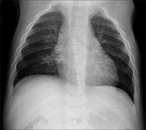 Rx de tórax evidencia ausencia de clavículas, en un paciente portador de displasia cleidocraneal.