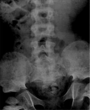 Rx frontal localizada a nivel lumbar muestra estrechamiento de distancia interpedicular en paciente con diagnóstico de acondroplasia.