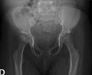 Rx de pelvis de paciente portadora de mucopolisacaridosis, evidencia alteraciones típicas de esta enfermedad.