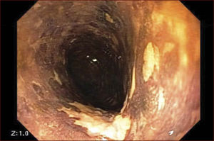 Cromoscopia con lugol revela lesión neoplásica deprimida no coloreada del tercio medio del esófago.