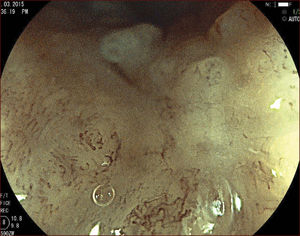 Cromoscopia digital y magnificación muestra los vasos dilatados e irregulares en la zona deprimida de la lesión.