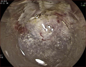 Utilizando capuchón en la punta del endoscopio se procede a la disección de la capa submucosa, observe el nível correcto de la disección (SM profunda junto a la muscular propia).