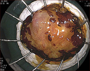 Espécimen fijado, coloreado con lugol. La histología demostró carcinoma de células escamosas con invasión de la submucosa (SM2) e invasión vascular, con márgenes libres. Paciente derivado a quimioterapia y radioterapia complementaria.