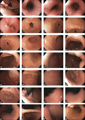 Endoscopia sistemática alfanumérica codificada (SACE) 1-Hipofaringe. 2- Esófago tercio superior. 3- Esófago tercio medio. 4- Esófago tercio inferior. 5- Hiato esofágico visión directa. 6- Anillo pilórico. 7- Antro, cara anterior. 8- Antro, curva menor. 9- Antro, cara posterior. 10- Antro, curva mayor. 11- Tercio distal cara anterior. 12- Tercio distal, curva menor. 13- Tercio distal, cara posterior. 14- Tercio distal, curva mayor. 15- Tercio medio, cara anterior. 16- Tercio medio, curva menor. 17- Tercio medio, cara posterior. 18- Tercio medio, curva mayor. 19- Tercio superior, curva mayor. 20- Tercio superior, cara antero-posterior. 21- Fornix. 22- Cardias en retroflexión. 23- Curva menor, tercio superior. 24- Curva menor, tercio medio. 25- Curva menor, tercio inferior. 26- Ángulo gástrico. 27- Bulbo duodenal. 28- Segunda porción duodenal.