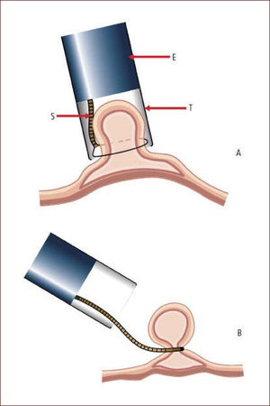 Técnica de mucosectomía con cap A. El endoscopio (E) se aproxima a la lesión y la succiona dentro del cap transparente (T) quedando la lesión por dentro del asa (S). B. La lesión es estrangulada y resecada con corriente electroquirúrgica. Diagrama modifcado de Tada et al20.