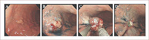 Técnica de strip biopsy A. Lesión superficial levantada tipo Is localizada en tercio distal de cuerpo gástrico, cara anterior. B. Marcación e inyección en la submucosa con SSN. C. Tracción con el fórceps y cierre del asa de polipectomía. D. Área post resección.