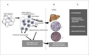 A. Adipocitos hipertrofiados liberan citoquinas y quemoquinas lo que induce resistencia a la insulina local y sistémica. Liberación de ácidos grasos libres a la circulación y acumulación en el hígado. B. EHNA: esteatohepatitis noalcoholica; a y b: histología hepática con esteatosis, balonamiento celular e inflamación. C. Mecanismos de progresión (esteatosis-esteatohepatitis no alcohólica).