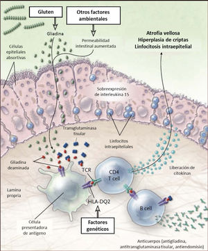 Esquema fisiopatología en la enfermedad celíaca El gluten es digerido en el lumen y ribete en cepillo intestinal a péptidos, principalmente gliadina. La gliadina induce cambios a través de la inmunidad innata en el epitelio y de la inmunidad adaptativa en la lámina propria. En el epitelio el daño provoca sobreexpresión de interleukina 15, que a la vez activa los linfocitos intraepiteliales. Estos linfocitos se tornan citotóxicos y dañan los enterocitos que expresan proteínas de stress en su superficie. En situaciones de aumento de la permeabilidad intestinal, como en las infecciones, la gliadina entra a al lamina propria donde es deaminada por la enzima transglutaminasa tisular, permitiendo la interacción con el HLA-DQ2 o HLA-DQ8 de la superficie de las células presentadoras de antígenos. La gliadina es presentada entonces a los linfocitos T CD4+ resultando en mayor producción de citokinas que causan daño. Todo esto lleva a la atrofia vellositaria e hiperplasia de criptas, y a la expansión de linfocitos B con la consecuente producción de anticuerpos. Adaptado de 13.